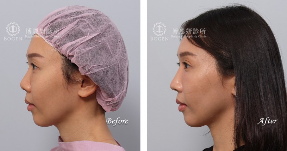 韓式隆鼻,結構式隆鼻,博恩妍